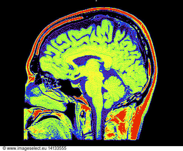 mri-of-normal-brain-mri-of-normal-brain-38-years-old-38-years-old-brain