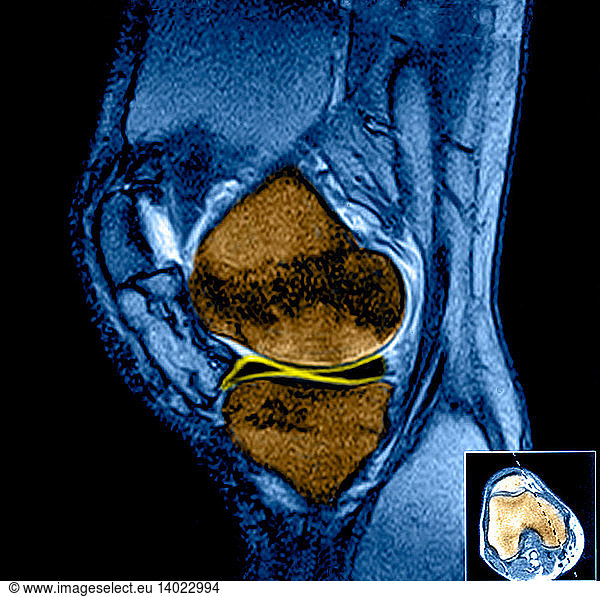 Mri Of Right Knee Mri Of Right Kneeinternal Menisciinternal Meniscuskneemagnetic Resonance