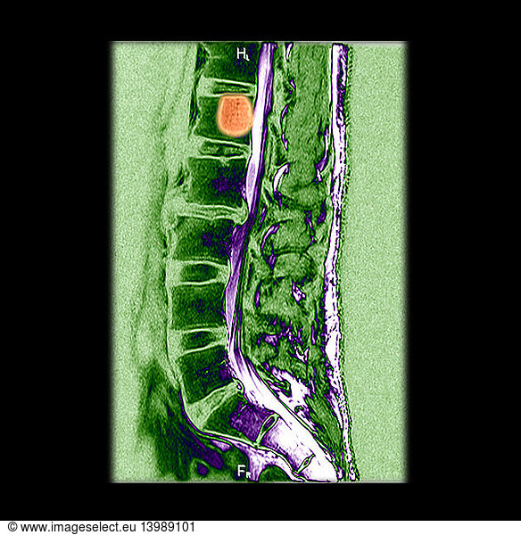 Mri Of Vertebral Hemangioma Mri Of Vertebral Hemangiomabenign