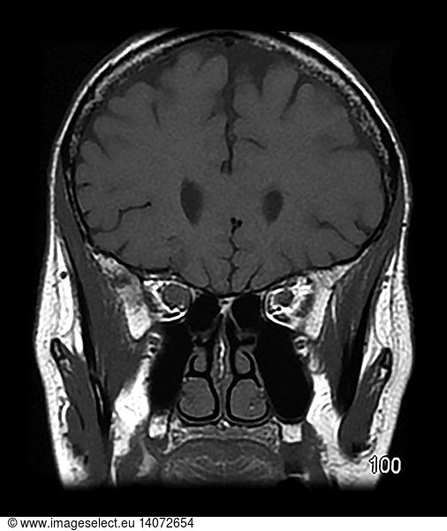 Mri Optic Nerve Glioma In Adult Mri Optic Nerve Glioma In Adult Enlargement Of Optic Nerve