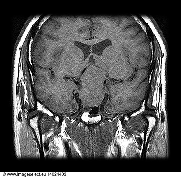 Mri Pituitary Macroadenoma Mri Pituitary Macroadenoma,brain Mass,brain 