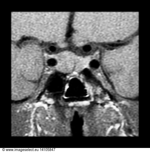 MRI Pituitary Microadenoma MRI Pituitary Microadenoma,abnormal mri ...