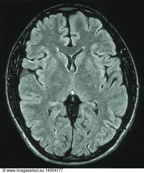 Arachnoid Cyst Mri Brain Hot Sex Picture