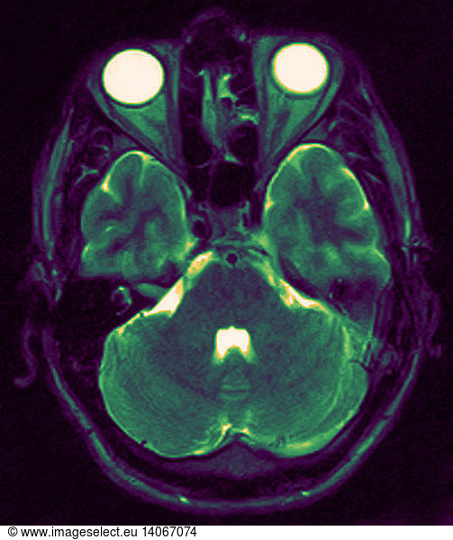 Mri Showing Arachnoid Cyst Mri Showing Arachnoid Cyst Abnormal