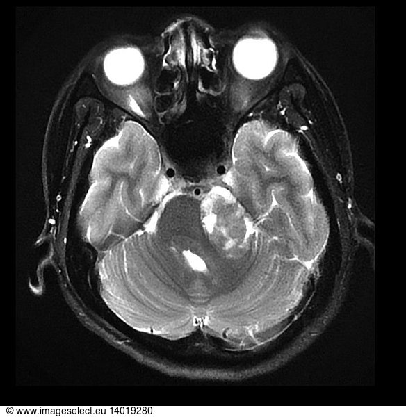 MRI Vestibular Schwannoma and Cavernous Sinus Lesion MRI Vestibular ...