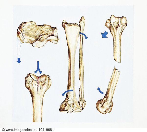 Musculoskeletal  (locomotor) system  indirect fractures of the bones  drawing