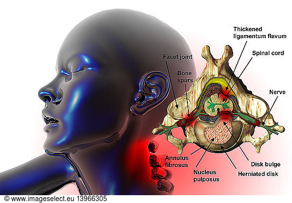 Neck Pain Neck Pain, Illustration,annulus fibrosus,spurs,pathological ...