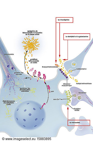 Neuron with neurofibrillary degeneration process Neuron with ...