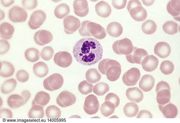 Neutrophil Neutrophil, Drumstick Chromosome,barr body,blood smear,blood ...