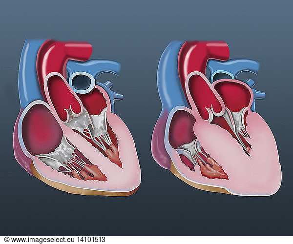 Normal and enlarged heart  illustration