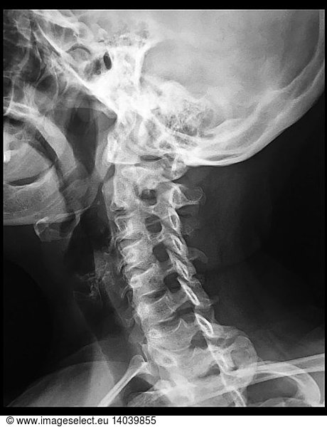 Normal Cervical Spine Normal Cervical Spine X Raycervicalforamenimaging Rights Managed 8710