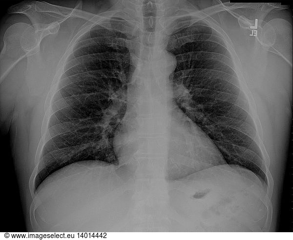 Normal chest X-ray Normal chest X-ray,bronchial bifircation carina ...