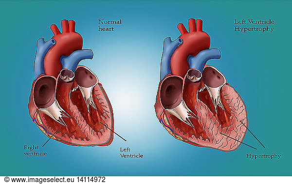 Normal Heart Vs Left Ventricle Hypertrophy Normal Heart Vs Left