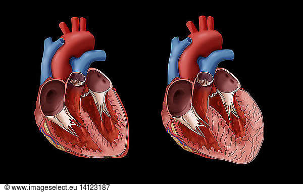 Normal Heart vs. Left Ventricle Hypertrophy Normal Heart vs. Left ...