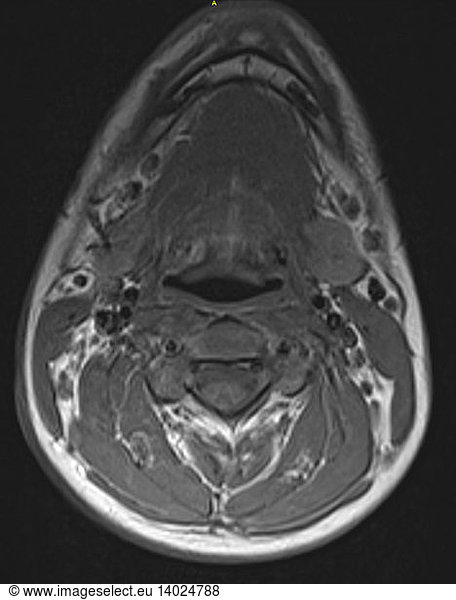 Normal neck and cervical spine Normal neck and cervical spine, MRI ...