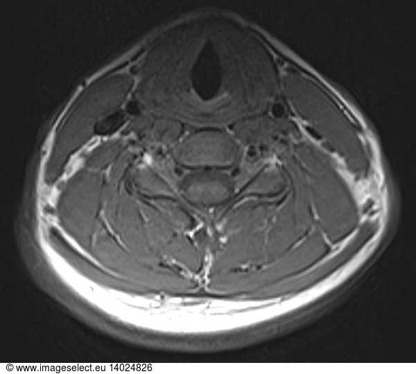 Normal neck and cervical spine Normal neck and cervical spine, MRI ...