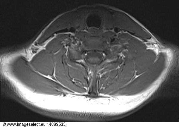 Normal neck and cervical spine Normal neck and cervical spine, MRI ...