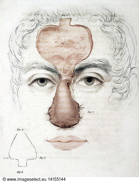 Nose Reconstruction  1815 Medical Text