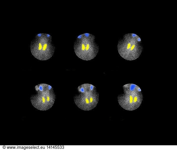 Nuclear Medicine Scan of Thyroid Gland Nuclear Medicine Scan of Thyroid ...