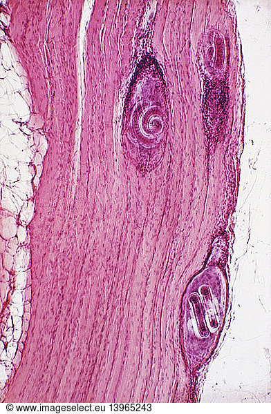 Nurse Cell Parasite Nurse Cell Parasite, Trichinella Spiralis,eosin 