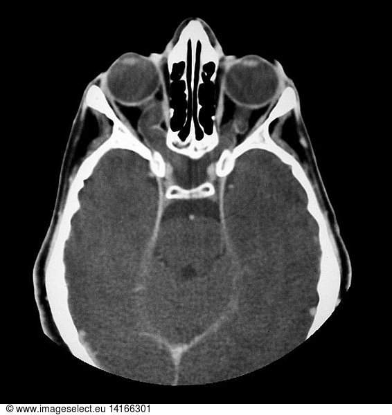 optic-nerve-tumors-optic-nerve-tumors-ct-in-ng1-ct-of-brain-in