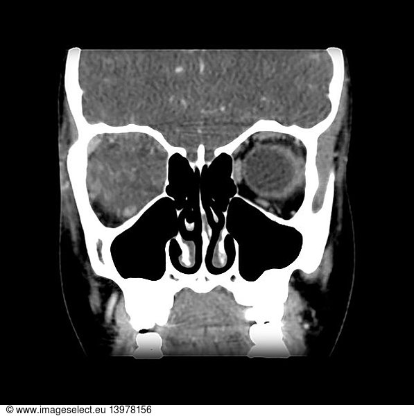 Orbital Pseudotumor on CT Orbital Pseudotumor on CT,abnormal ct orbit ...