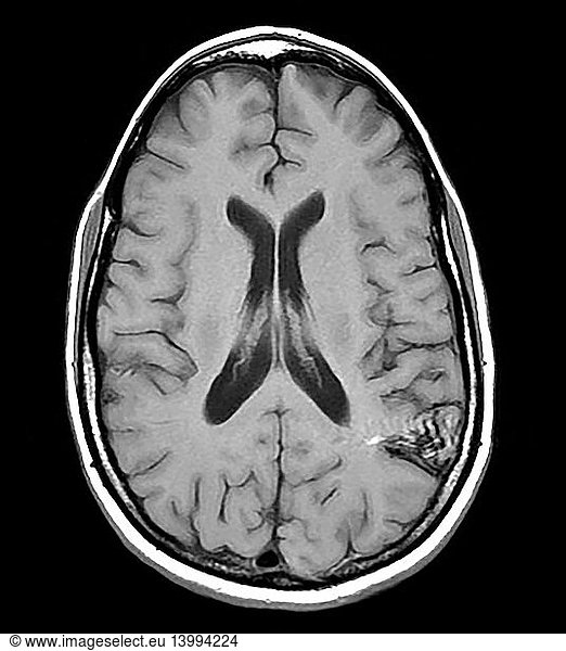 Parietal Lobe AVM Parietal Lobe AVM, MRI,abnormal blood vessels ...