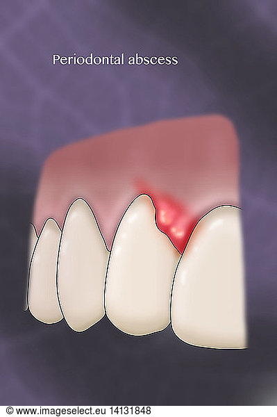 Periodontal Abscess Periodontal Abscess, Illustration,abscess,bacterial ...