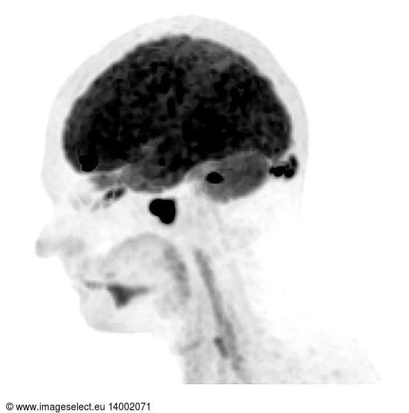 pet-ct-in-the-management-of-lymphomas-staging-re-staging-and-treatment