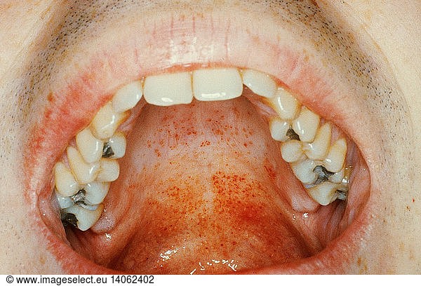 pharyngeal-petechiae-pharyngeal-petechiae-ebv-glandular-fever