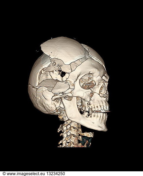 Photograph of a three-dimensional CT reconstruction of the bony skull with bullet wounds