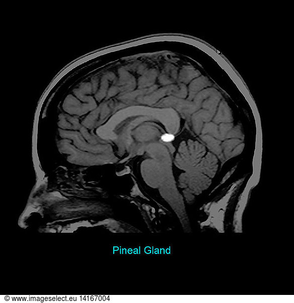 Pineal Gland Pineal Gland, Sagittal MRI,brain anatomy,brain,brain ...