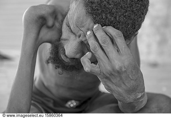 Portrait of homeless man with congenital disease in Recife downtown