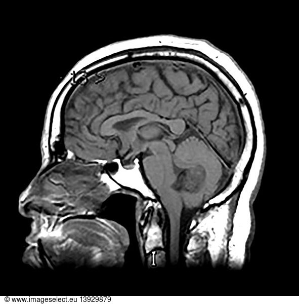 Posterior Fossa Epidermoid Tumor Posterior Fossa Epidermoid Tumor ...