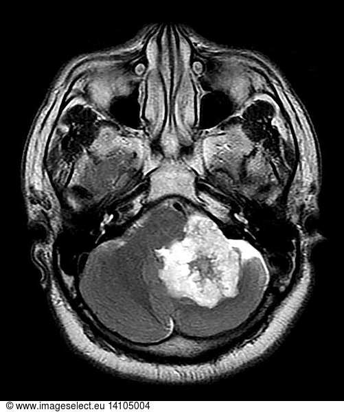 Posterior Fossa Epidermoid Tumor Posterior Fossa Epidermoid Tumorabnormal Mr Headcholesteatoma 4156