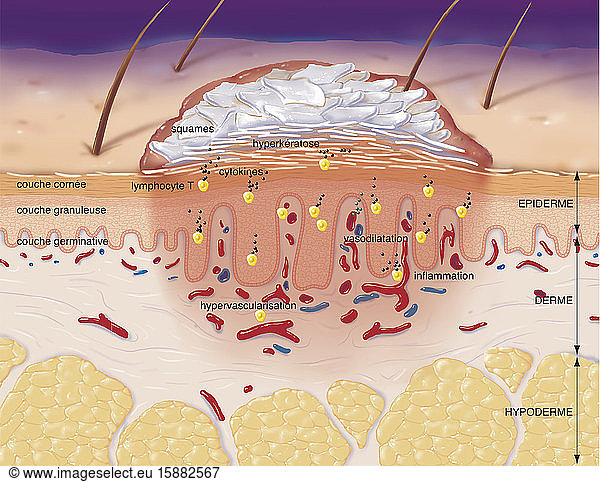 Psoriasis : cut of skin with hyperkeratosis Psoriasis : cut of skin ...