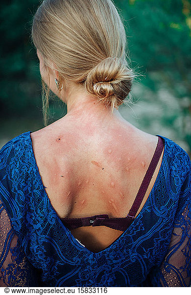 Rücken einer Frau mit Mückenstichen