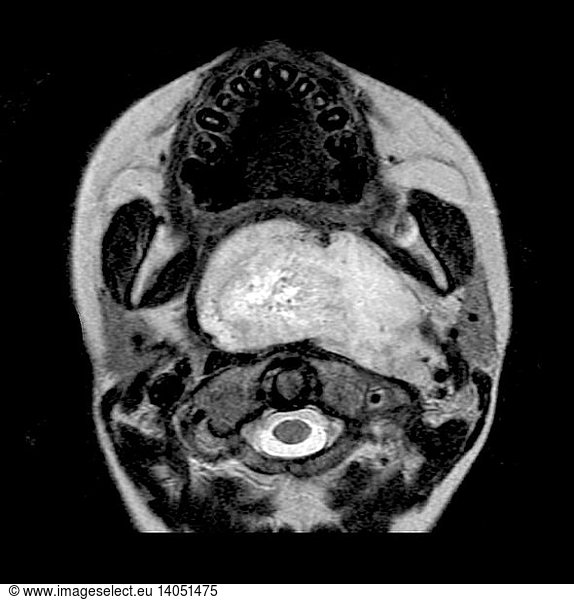 Rhabdomyosarcoma Rhabdomyosarcoma, MRI,abnormal,abnormality,brain