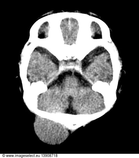 Rhabdomyosarcoma Head and Neck in Newborn Rhabdomyosarcoma Head and