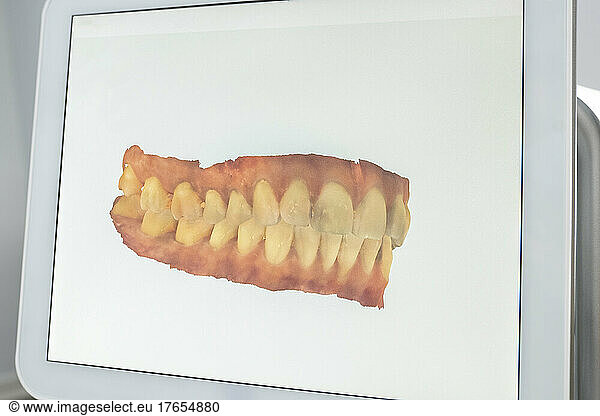 Scanned image of teeth on monitor screen at dental clinic