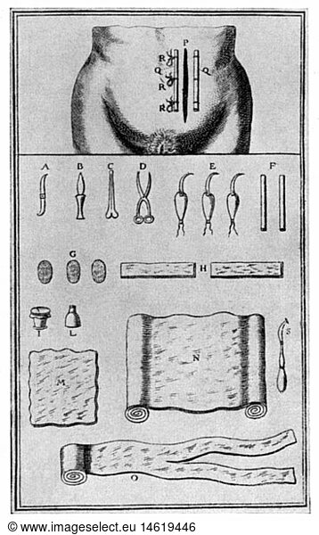 SG hist.  Medizin  Geburt / GynÃ¤kologie  Schema der Naht und Instrumente fÃ¼r den Kaiserschnitt  Kupferstich  aus: Jacques Mesnard  'Le Guide des Accoucheurs'  Paris  1753