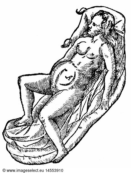 SG hist.  Medizin  Geburt / GynÃ¤kologie  SchnittfÃ¼hrung beim Kaiserschnitt  Holzschnitt  aus: Boudewijn Ronsse (1525 - 1597)  'Mescellanea seu epistolae medicinale'  Leiden  1590