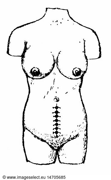 SG hist.  Medizin  Geburt / GynÃ¤kologie  weiblicher Torso mit vernÃ¤hter Bauchdecke nach Kaiserschnitt  Uganda  Zeichnung  nach Robert Felkin (1853 - 1926)  nach 1879