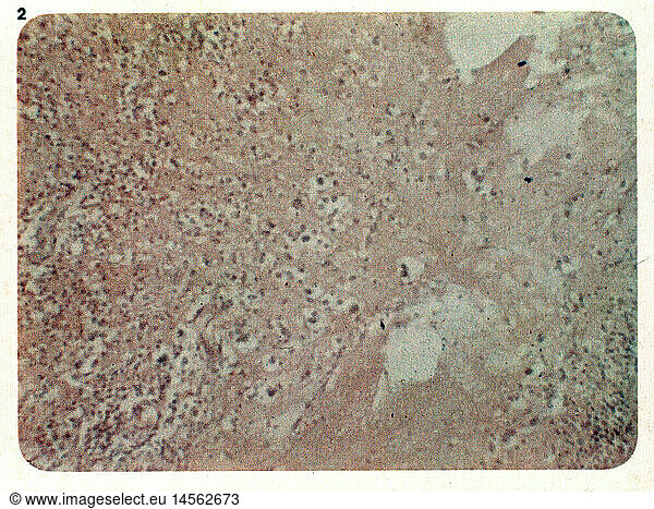 SG hist.  Medizin  Krankheiten  Blastomykose  Granulationsgewebe mit SproÃŸzellen von Blastomyces dermatitidis  20. Jahrhundert