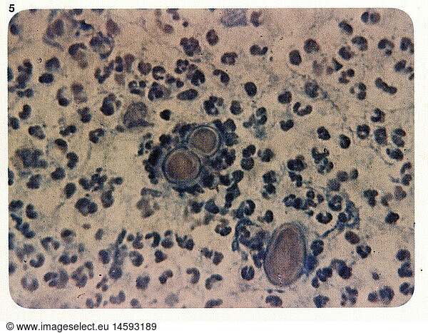 SG hist.  Medizin  Krankheiten  Blastomykose  SproÃŸzellen umgeben von Leukozyten  20. Jahrhundert