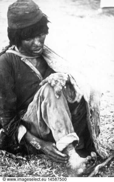 SG hist.  Medizin  Krankheiten  Lepra  Leprakranker  Nepal  20. Jahrhundert