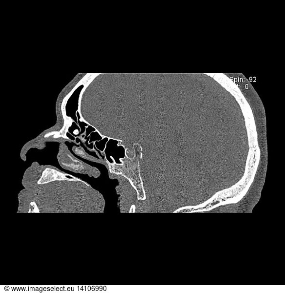 Sinus Osteoma Sinus Osteoma,computed tomography,ct scan,ethmoid osteoma ...