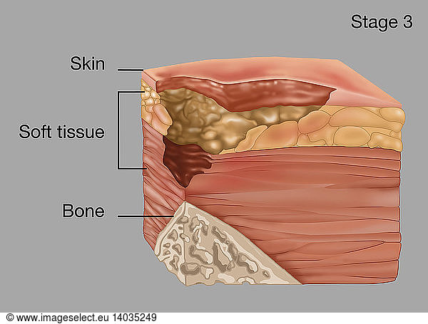 Stage 3 of a Bedsore Stage 3 of a Bedsore, Illustration,annotated,bed ...