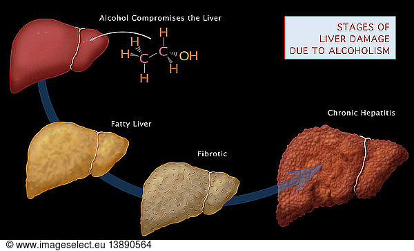 Stages of Liver Damage Stages of Liver Damage,abnormal,abnormality ...