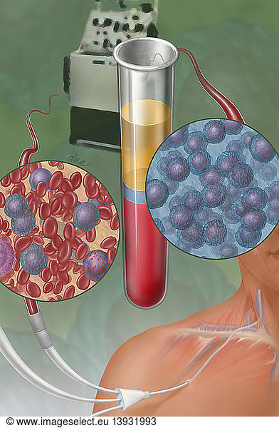 Stem Cell Transplantation  Illustration